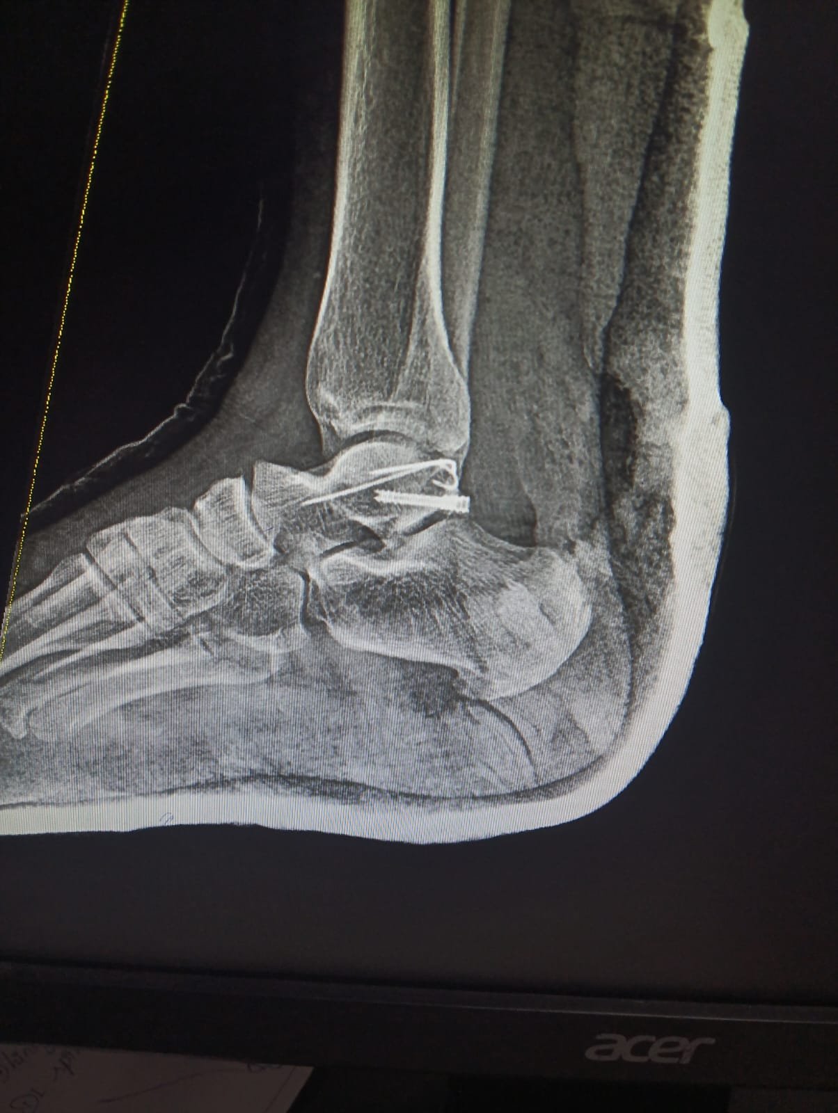 Talar Fracture Herbert Screw Fixation